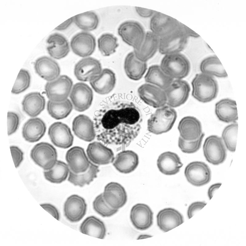 Metamielocita eosinofilo - Anomalia di Pelger - Hùet