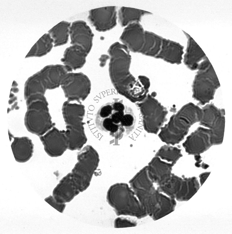 Cellula gemellare - neutrofilo con due nuclei, uno a due e uno a tre segmenti. Anomalia di Pelger - Hùet