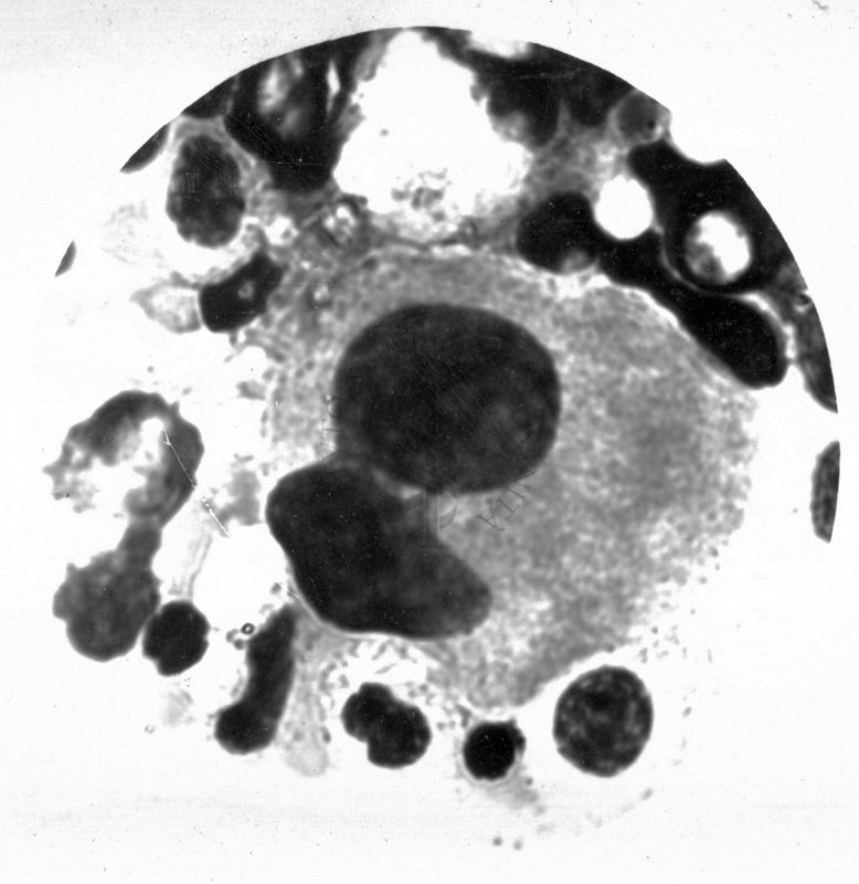 Megacariocito nel midollo osseo Anomalia di Pelger  - Hùet