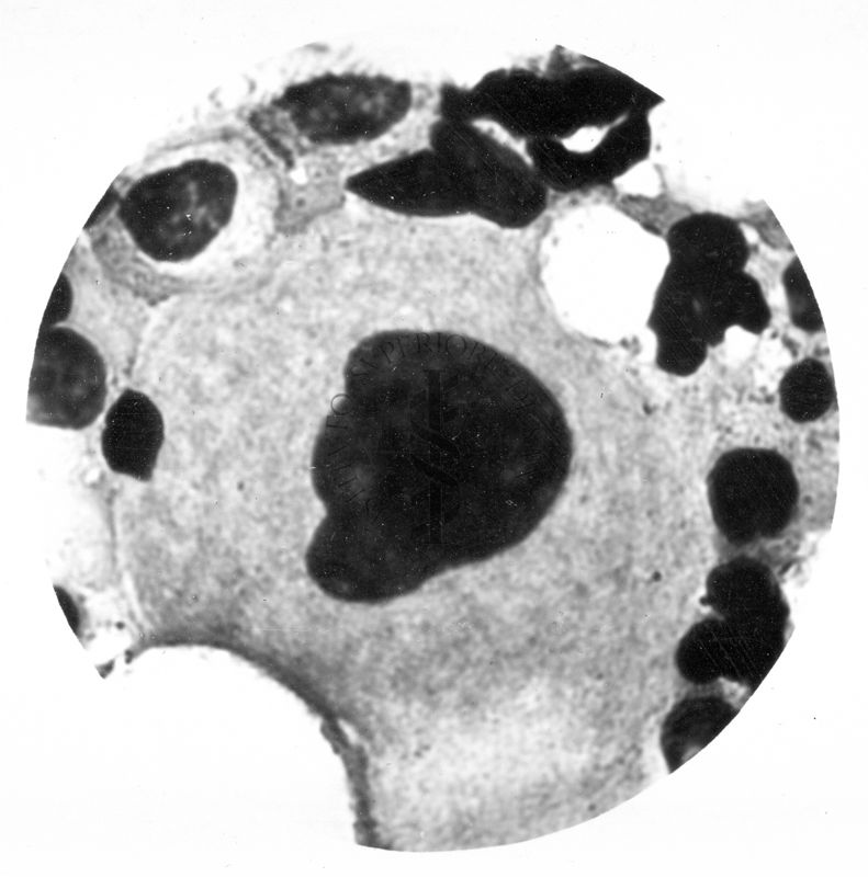 Megacariocito nel midollo osseo Anomalia di Pelger - Hùet