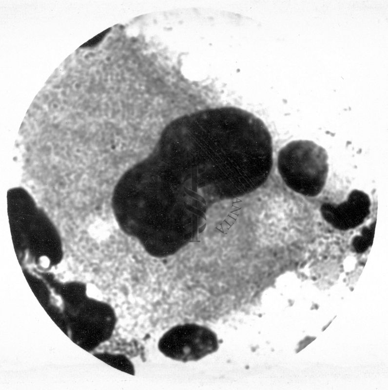 Megacariocito nel midollo osseo Anomalia di Pelger - Hùet