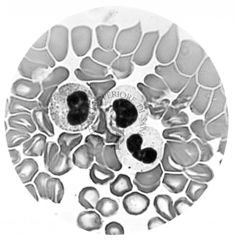 Mielocito e metamielocito neutrofilo. Mielocito eosinofilo in circolo