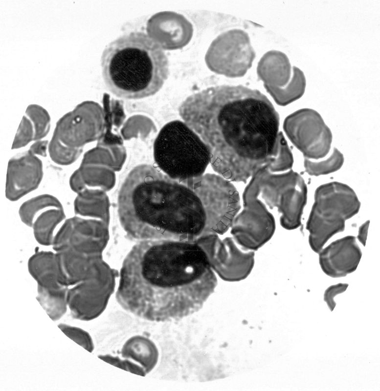 Promielociti neutrofili nel midollo osseo Anomalia di Pelger - Hùet