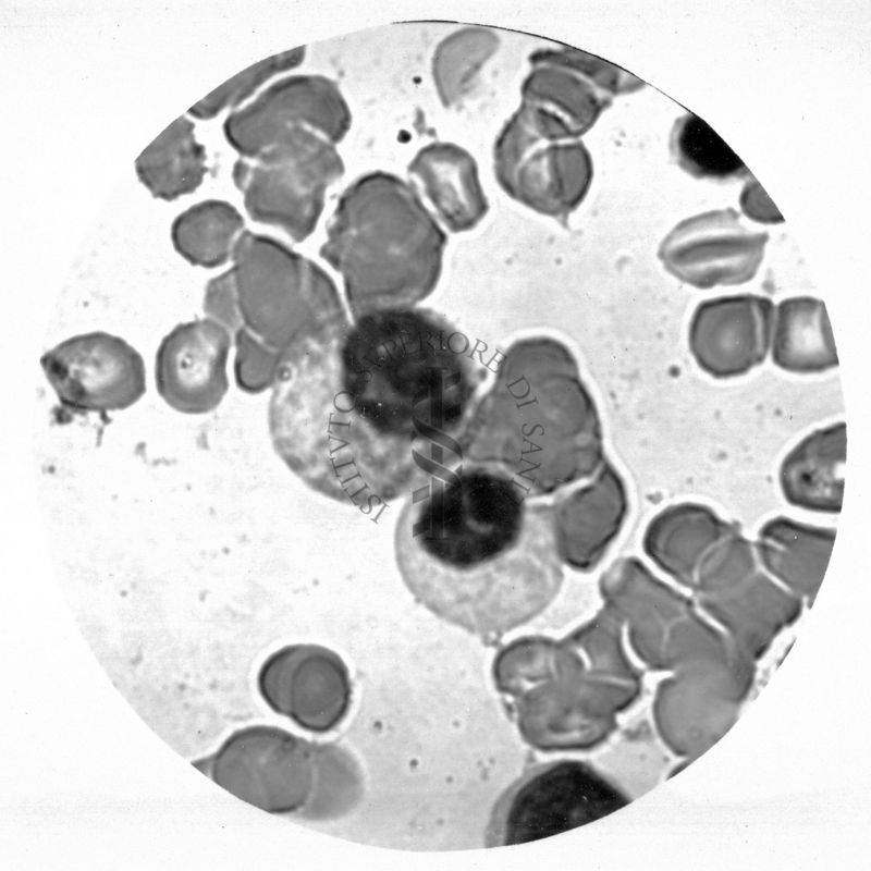 Promielocito e mielocito neutrofilo nel midollo osseo. Anomalia di Pelger - Hùet