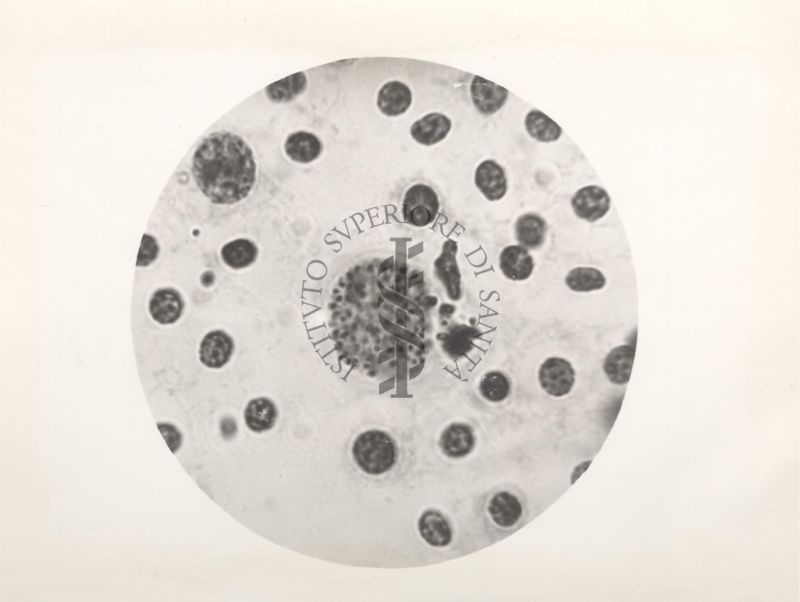 Plasmodium gallinaceum: sviluppo endo istiocitario del parassita in una cellula reticolo endoteliale che ha fagocitato il pigmento (midollo osseo)