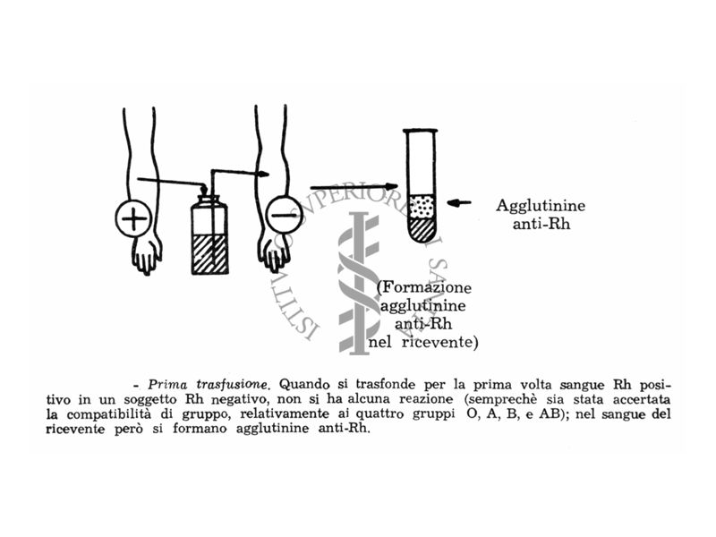 Diagramma dimostrativo della ipoimmunizzazione da R H per trasfusione