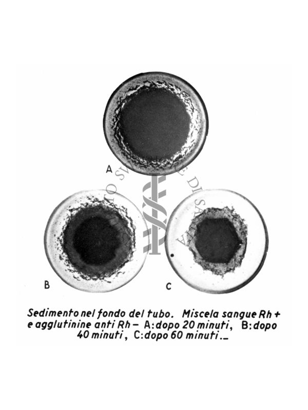 Sedimento nel fondo del tubo. Miscela sangue R H + e agglutinine anti RH - A. dopo 20 minuti. B. dopo 40 minuti C. dopo 60 minuti