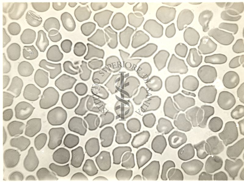 Globuli rossi maculati nella Malaria