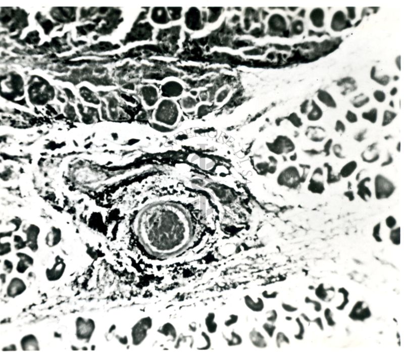 Necrosi di una parete di vaso nella zona di un flemmone muscolare nel coniglio 48 ore dopo l'infezione. Masse di streptococchi intorno al vaso