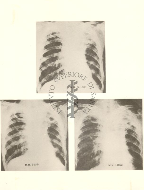 3 radiografie della gabbia toracica riguardanti l'azione dell'idrazide nella tubercolosi