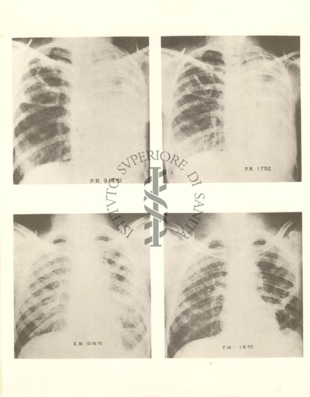 4 radiografie della gabbia toracica riguardanti l'azione dell'idrazide nella tubercolosi