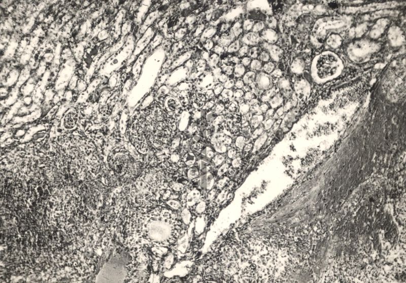Sezione istologica di rene di topino inoculato con Mycobacterium minetti. Focolai flogistici di varia grandezza ed emorragie nel parenchima renale