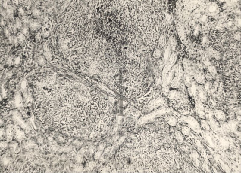 Sezione istologica di rene di cavia inoculata con Mycobacterium minetti. Focolai flogistici con capsule ben delimitate e micobatteri nei focolai