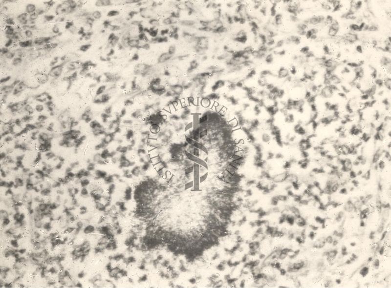 Sezione istologica di cuore di cavia inoculata con Mycobacterium minetti. Focolaio visto a forte ingrandimento