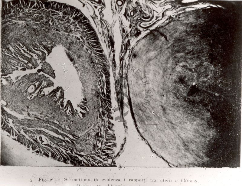 Micro fotografia riguardante l'evidenza i rapporti tra utero e fibroma.