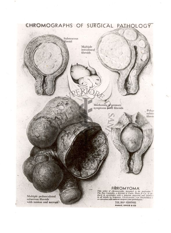 Fibroma dell'utero