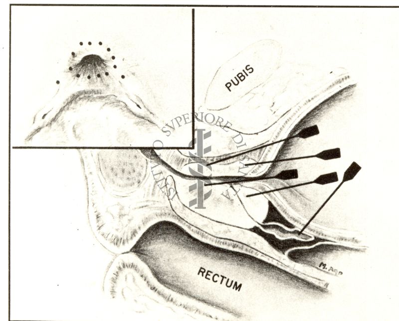 Fissazione degli aghi per iniezioni trans - vescicali