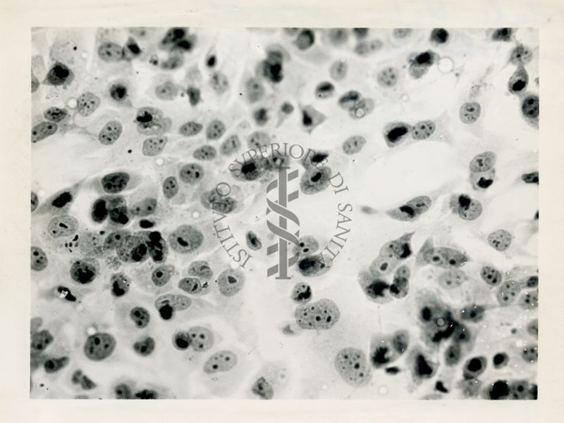 Cellule Hela con Polio-III°