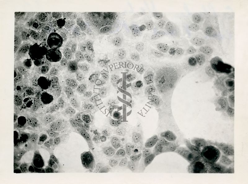 Cellule Hela con virus A.P.C. tipo IV°