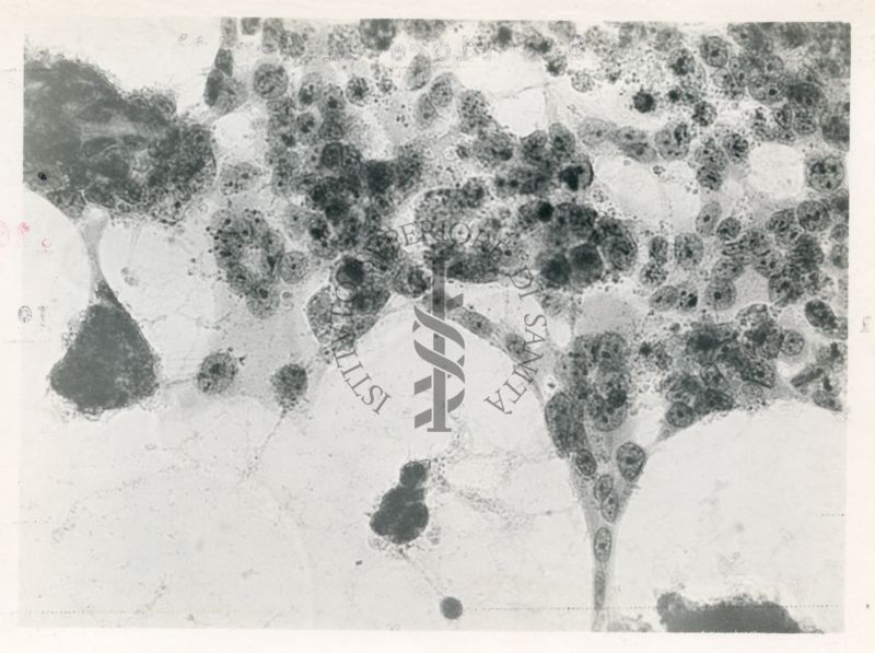 Cellule Hela infettate con virus della Parotite - Col. E.E.