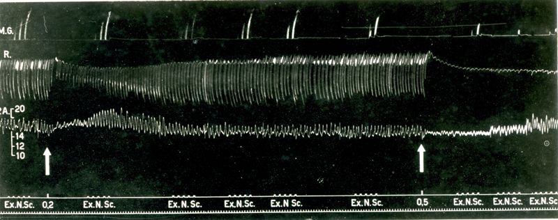 Tracciato dell'Azione curarizzante del trioduro del tri (trietilammonioetossi) 1,2,3 benzen (2559 F.). Effetto sulla trasmissione neuromuscolare, i movimenti respiratori e la pressione arteriosa del cane