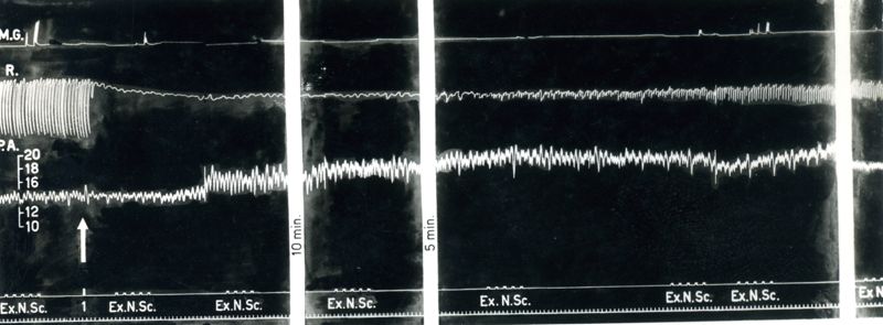 Tracciato dell'Azione curarizzante del trioduro del tri (trietilammonioetossi) 1,2,3 benzen (2559 F.). Effetto sulla trasmissione neuromuscolare, i movimenti respiratori e la pressione arteriosa del cane