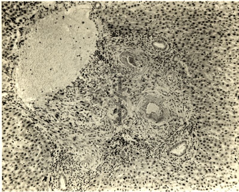 Periartrite nodosa del fegato nel ratto dopo trattamento con DCA