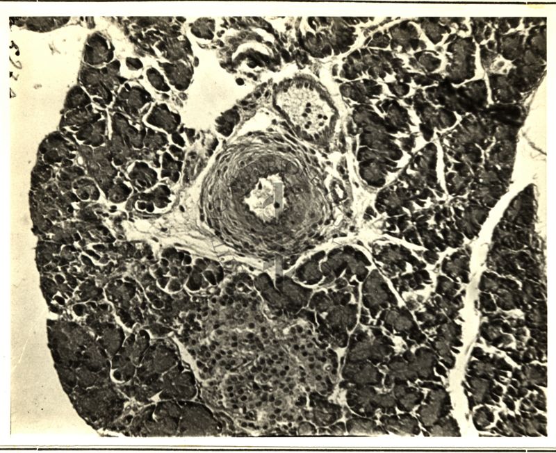 Vari tipi di periartrite nodosa prodotta nel pancreas del ratto dall'iperdosaggio di DCA