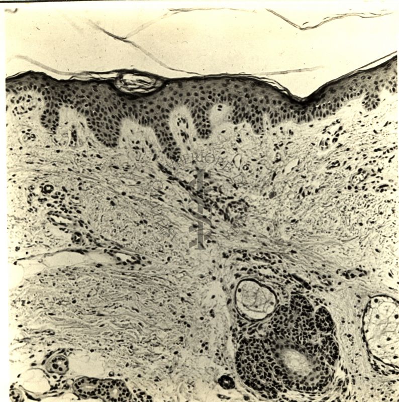 Sezione istologica di cute prelevata dal polpaccio della stessa paziente della figura precedente dopo 7 giorni di trattamento con l'ACTH