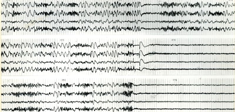 Tracciati elettroncefalografici di coniglio