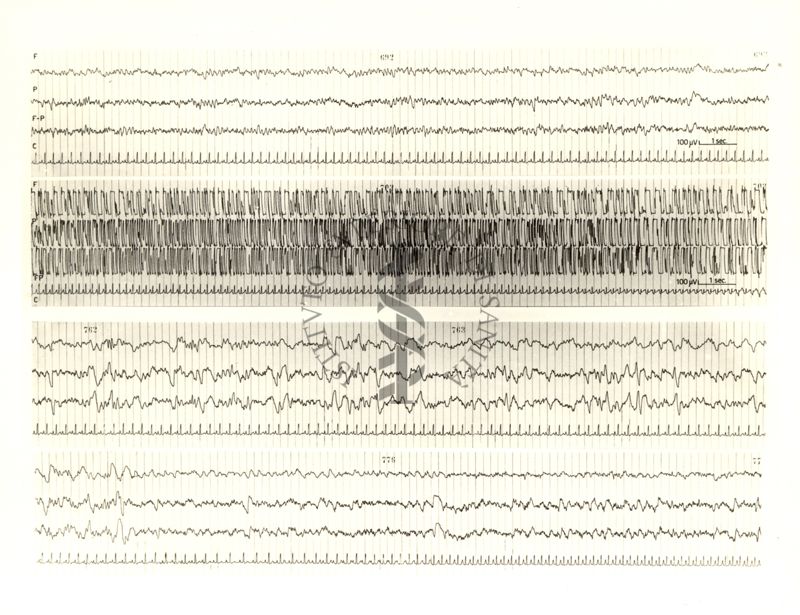 Tracciati elettroencefalografici di cane