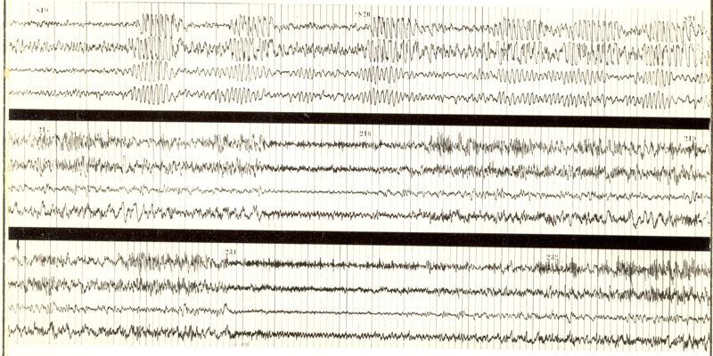 Tracciati elettroencefalografici