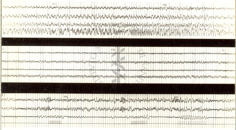 Tracciati elettroencefalografici