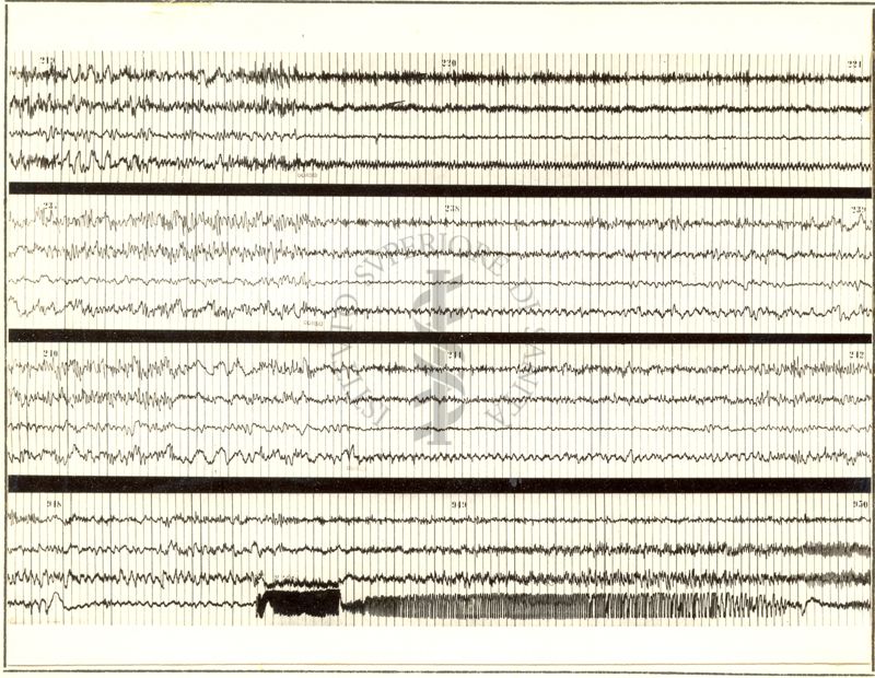 Tracciati elettroencefalografici