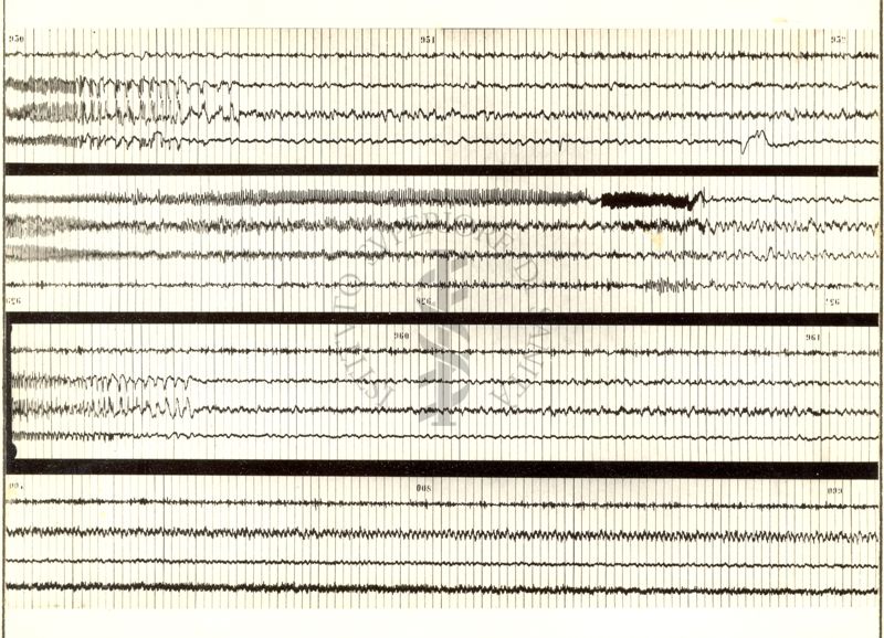 Tracciati elettroencefalografici