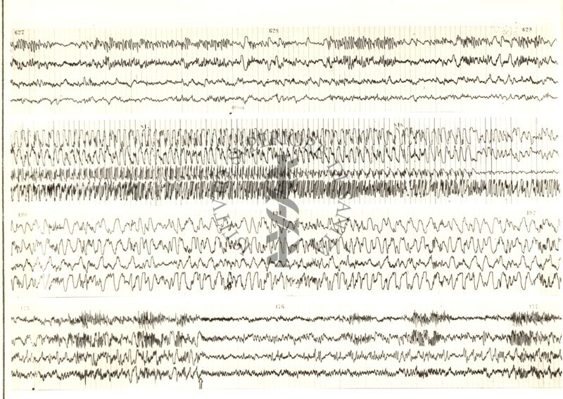 Tracciati elettroencefalografici di coniglio