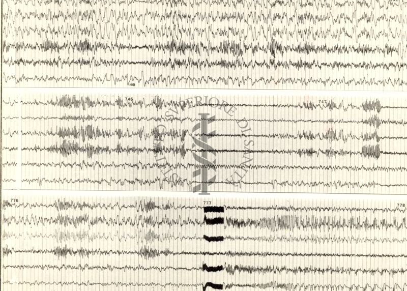 Tracciati elettroencefalografici