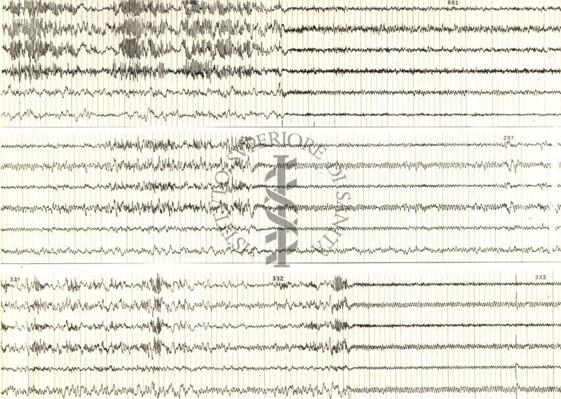 Tracciati elettroencefalografici