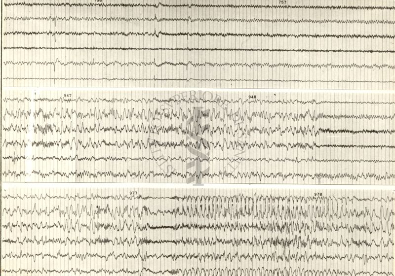 Tracciati elettroencefalografici