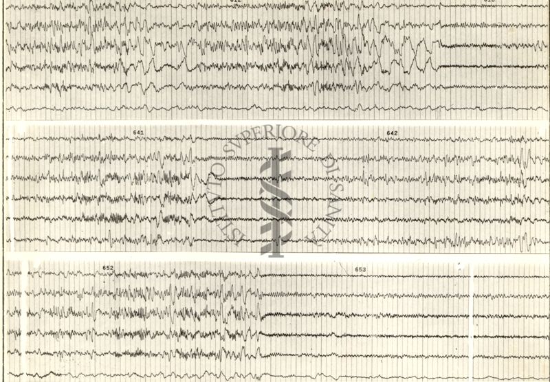 Tracciati elettroencefalografici