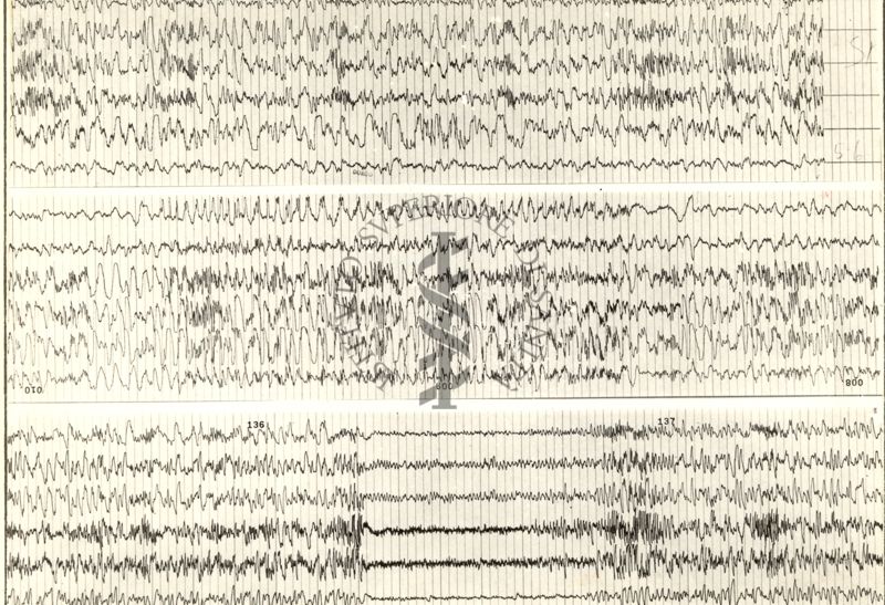 Tracciati elettroencefalografici