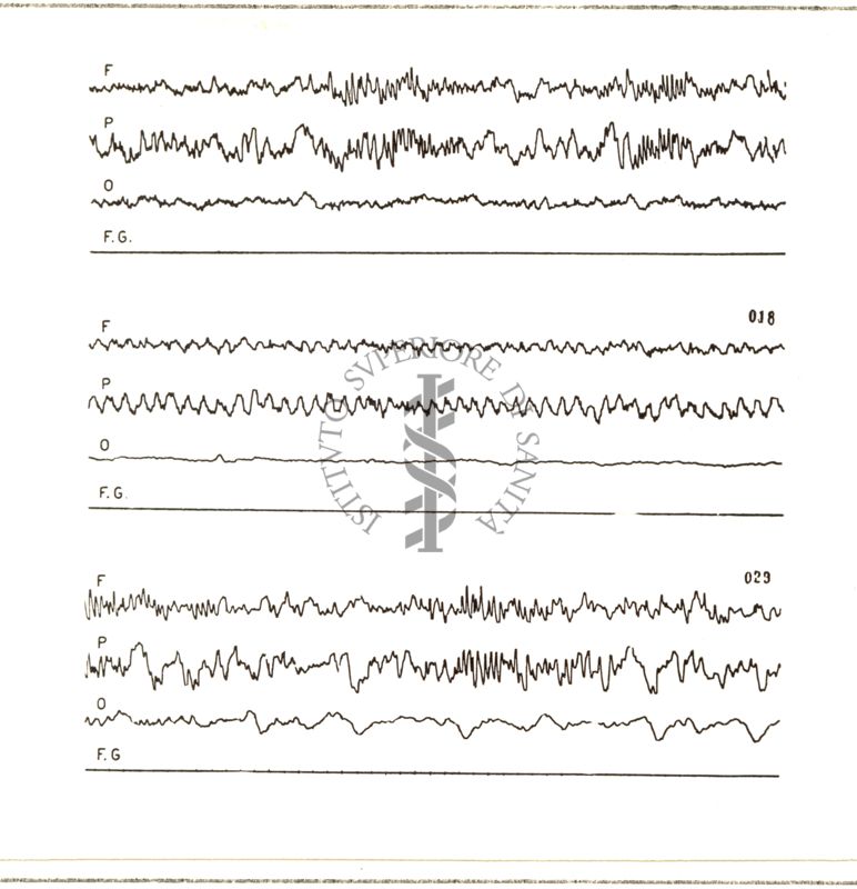 Tracciati elettroencefalografici