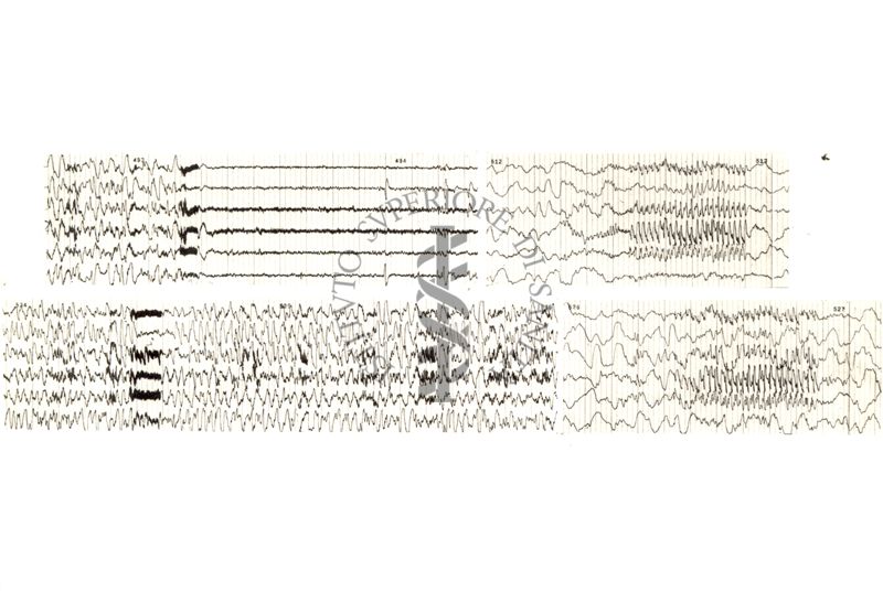 Tracciati elettroencefalografici