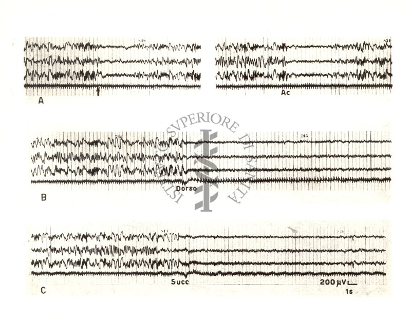 Tracciati elettroencefalografici