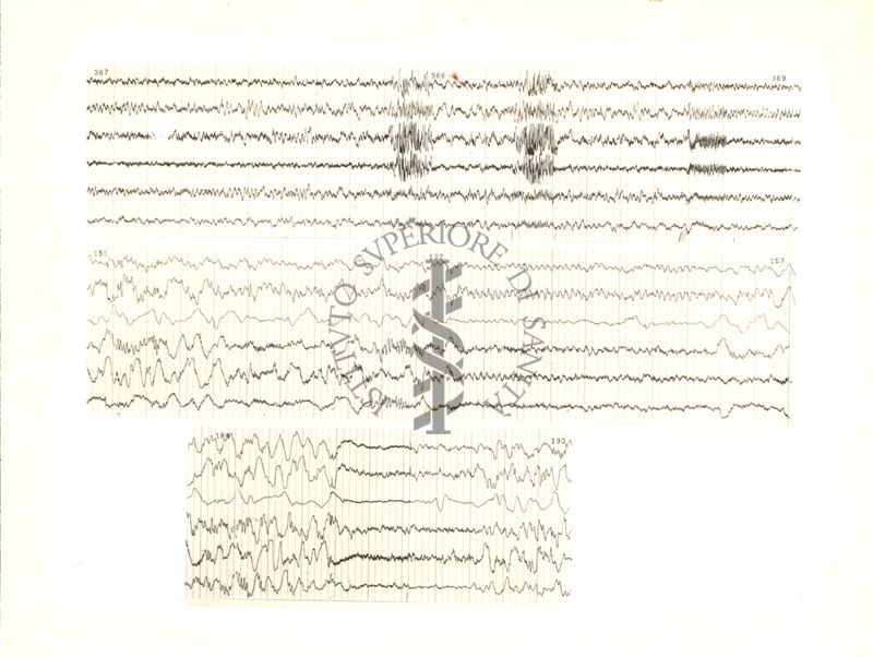 Tracciati elettroencefalografici