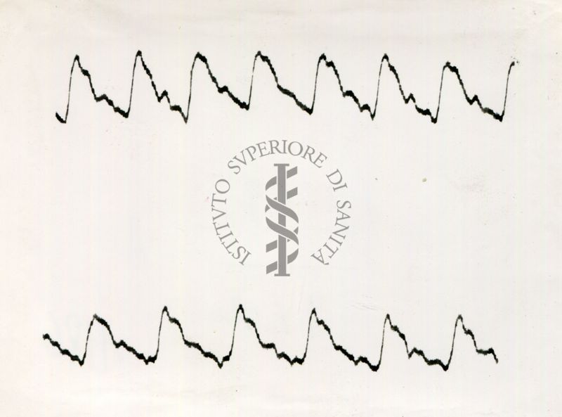 Registrazione piezografica del polso dell'arteria temporale nell'uomo sotto effetto di vari farmaci