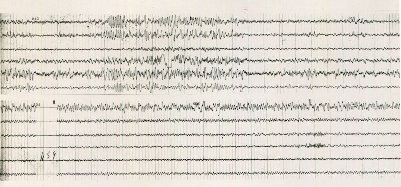 Tracciati elettroencefalografici di coniglio