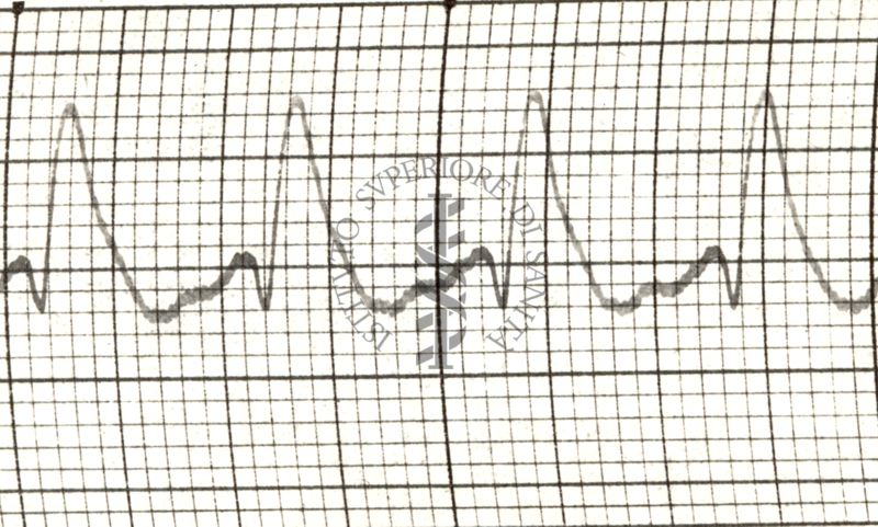 Azione del Nitrito di amile sulla arteria temporale nell'uomo