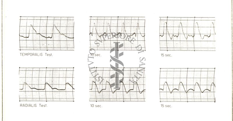 Registrazioni delle pulsazioni dell'arteria temporale nell'uomo sotto azione di vari farmaci