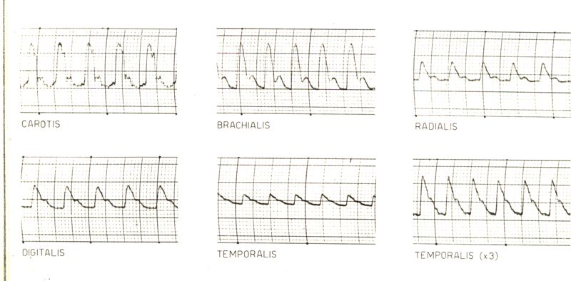 Registrazioni delle pulsazioni dell'arteria temporale nell'uomo sotto azione di vari farmaci